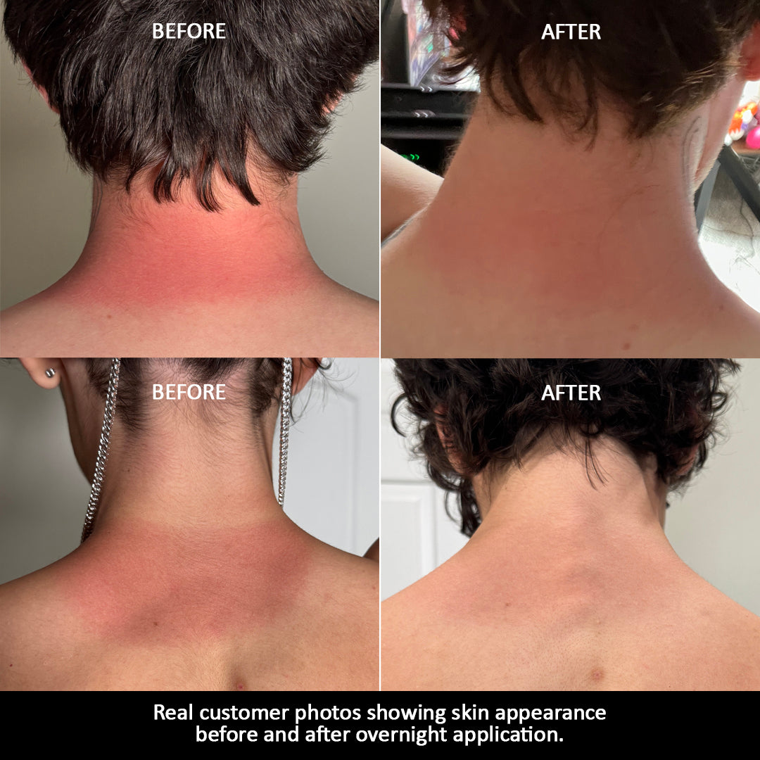 Burn Cream – Verefina